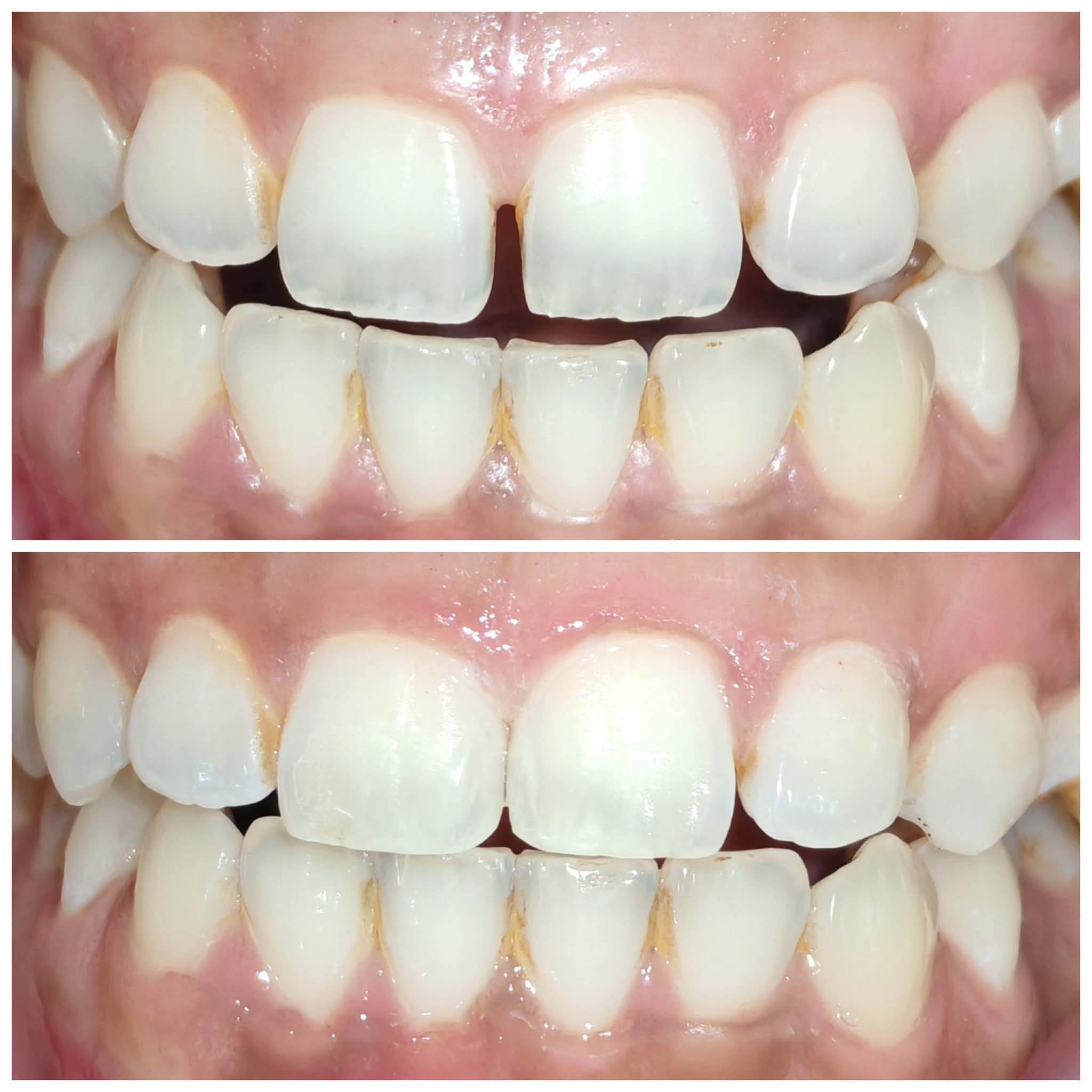 Denture (Removable teeth for elderly, per tooth)