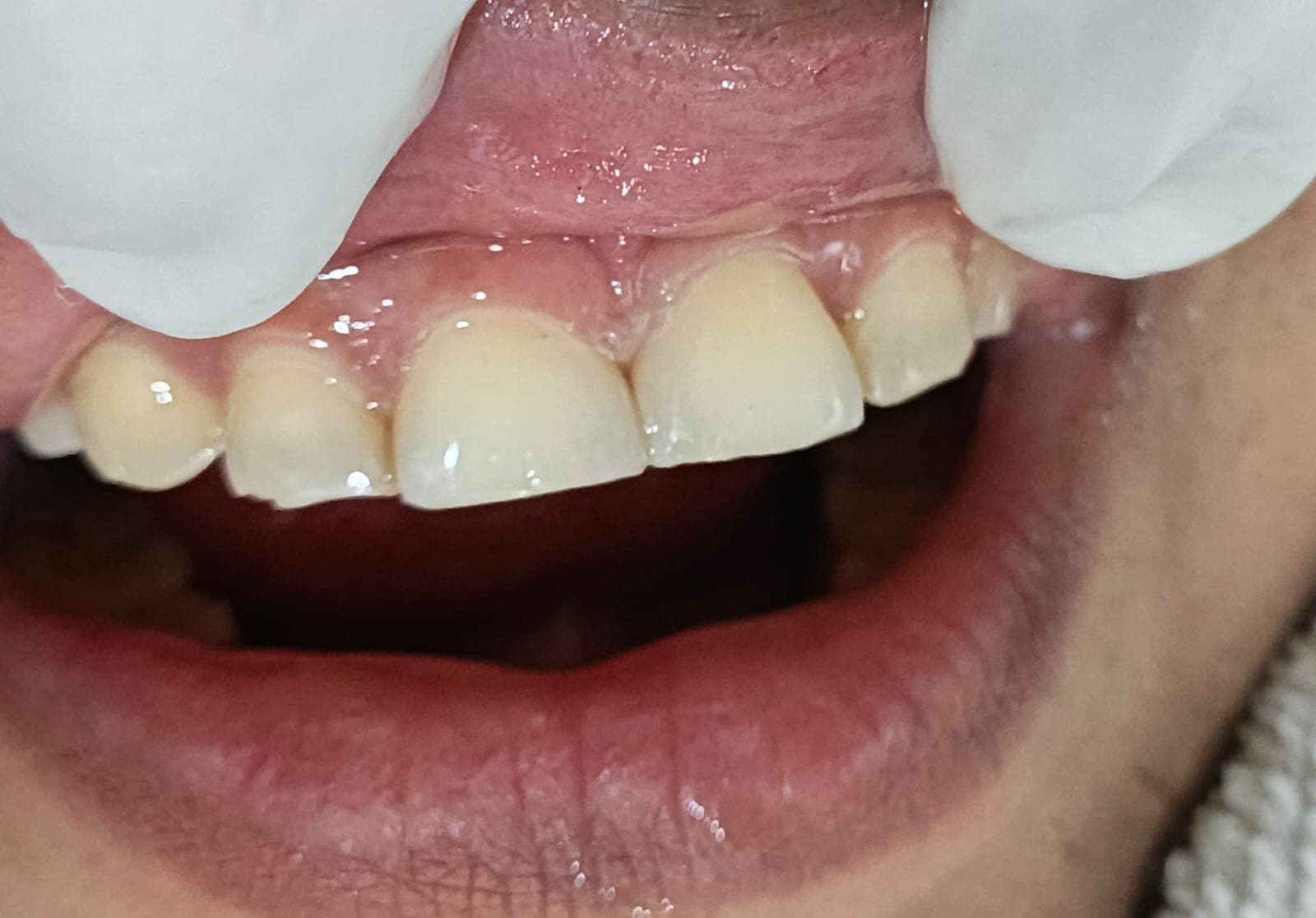 Pediatric Tooth Extraction