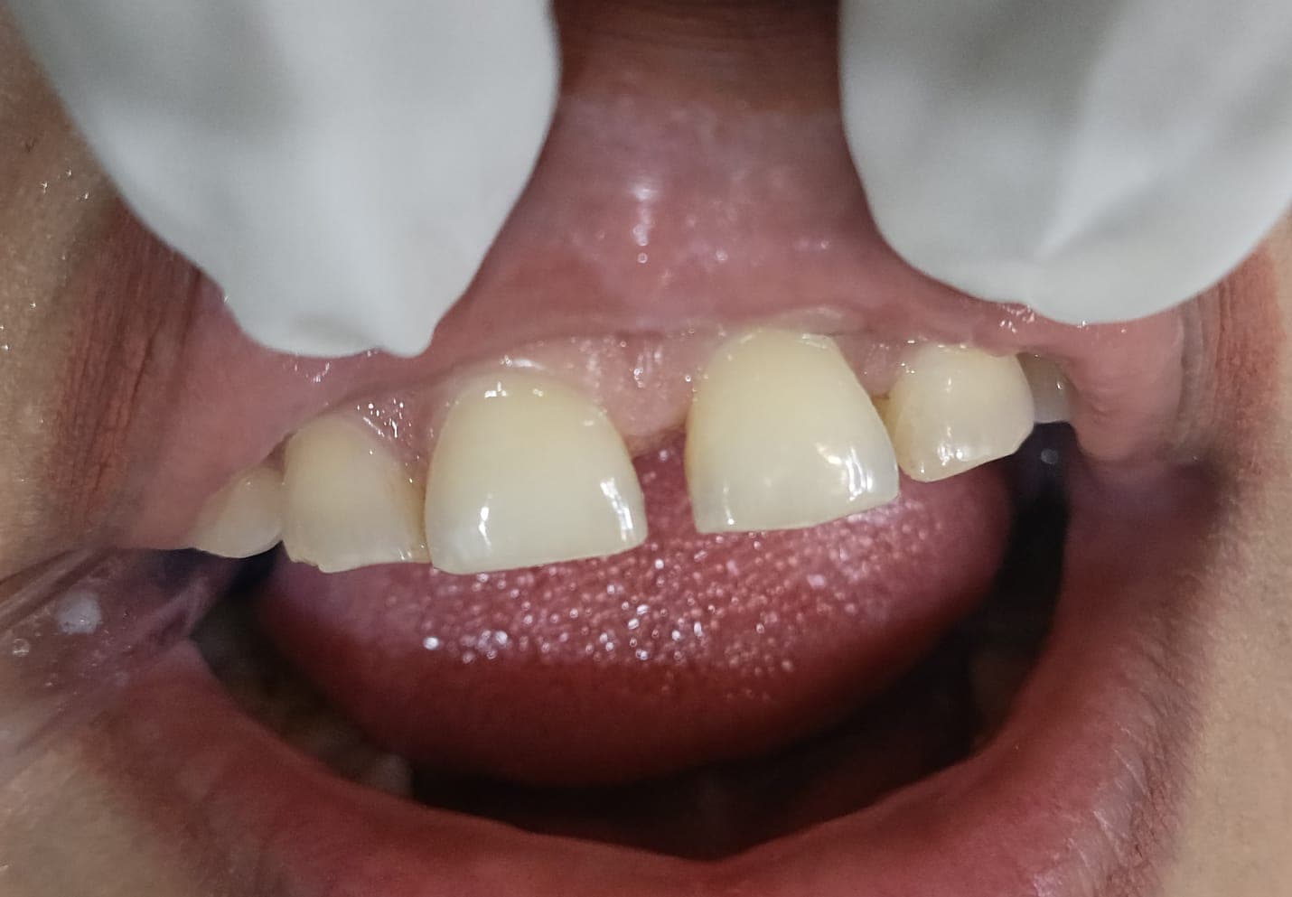 Pediatric Tooth Filling