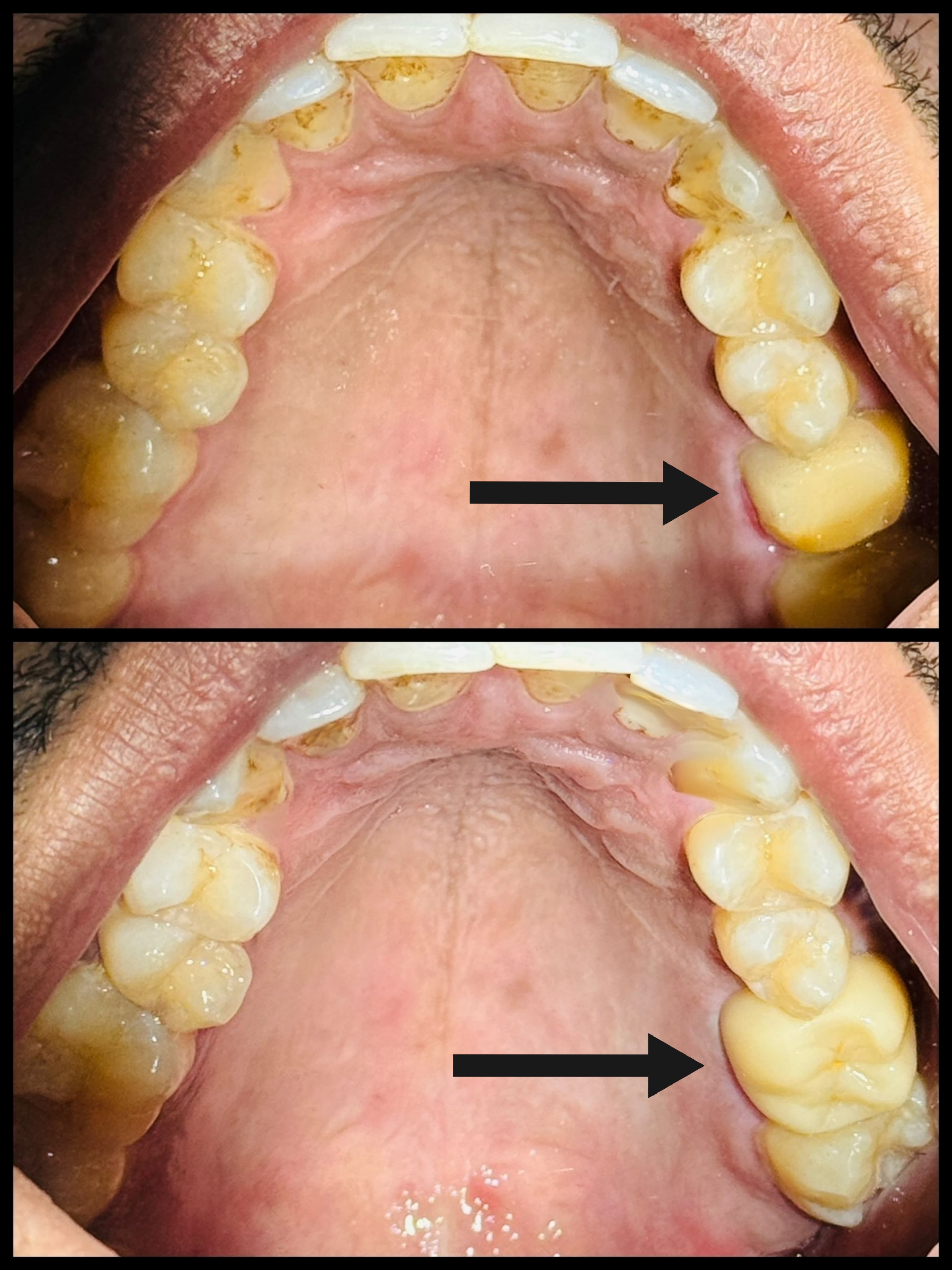 Zirconia Crown